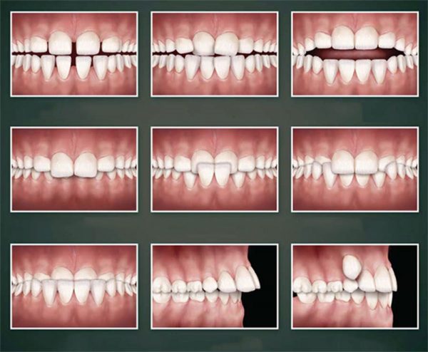 Tình trạng răng miệng trước khi thực hiện Niềng răng