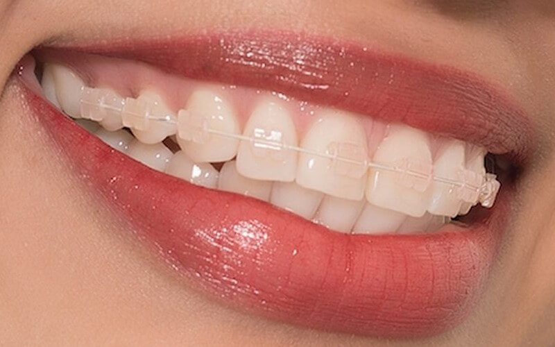 Niềng răng giúp hàm răng đều và đẹp hơn
