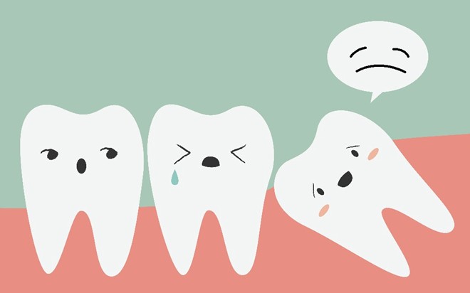 (Răng khôn mọc lệch gây đau nhức và ảnh hưởng đến răng kề cận)