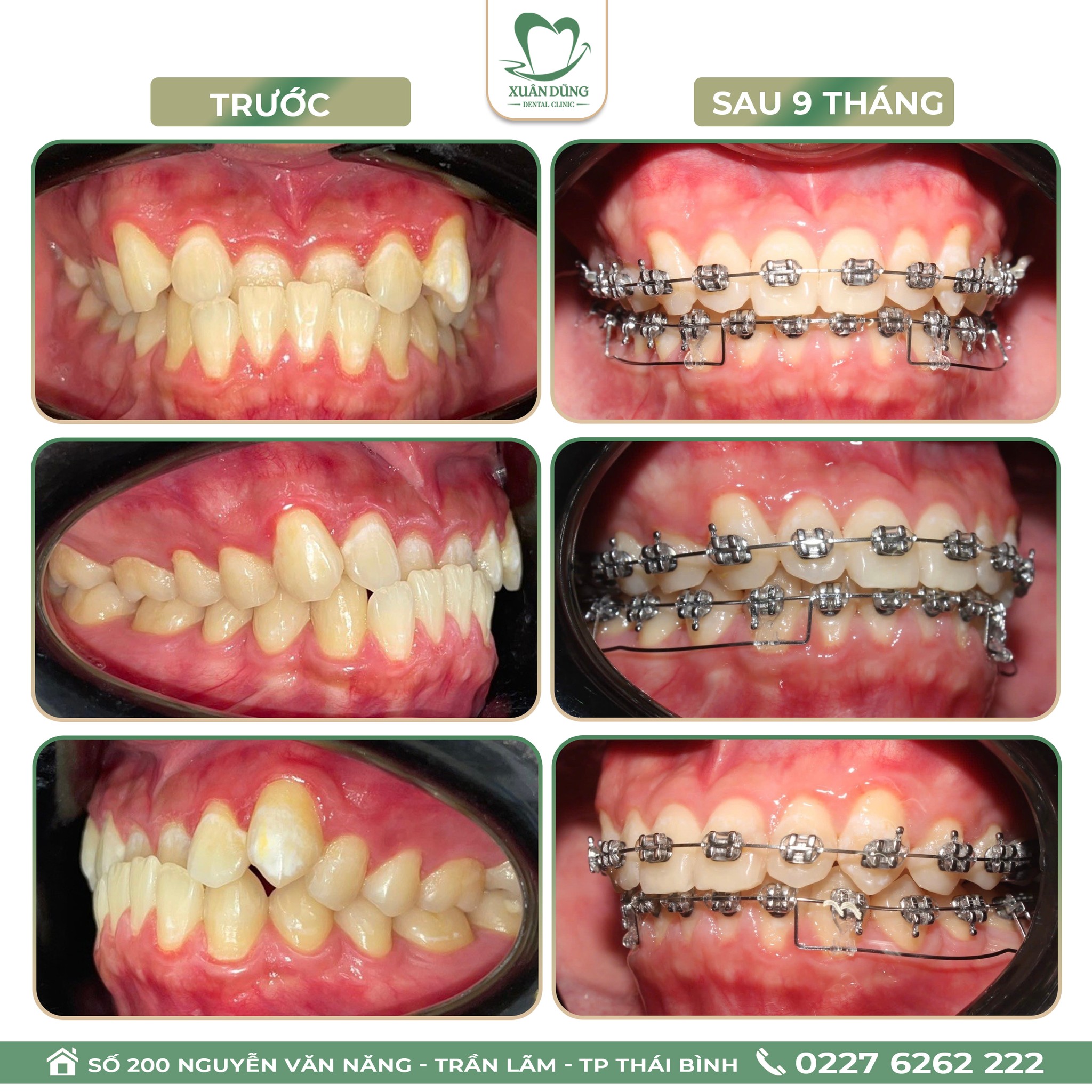 Niềng răng đem lại hàm răng đều đặn và thẩm mỹ