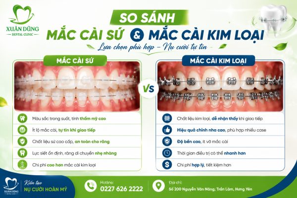 So sánh niềng răng mắc cài sứ và mắc cài kim loại